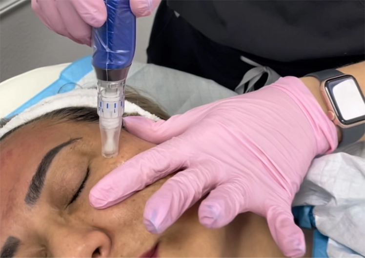 PRP Procedures
